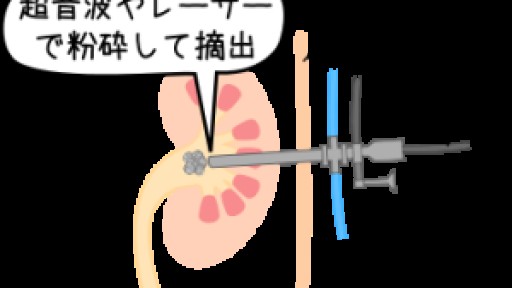 尿管結石の痛みはどれくらい続く？大きさは？