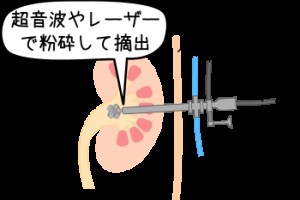 尿管結石の予防～食事と飲み物に気を付けて！低周波治療器の効果は？